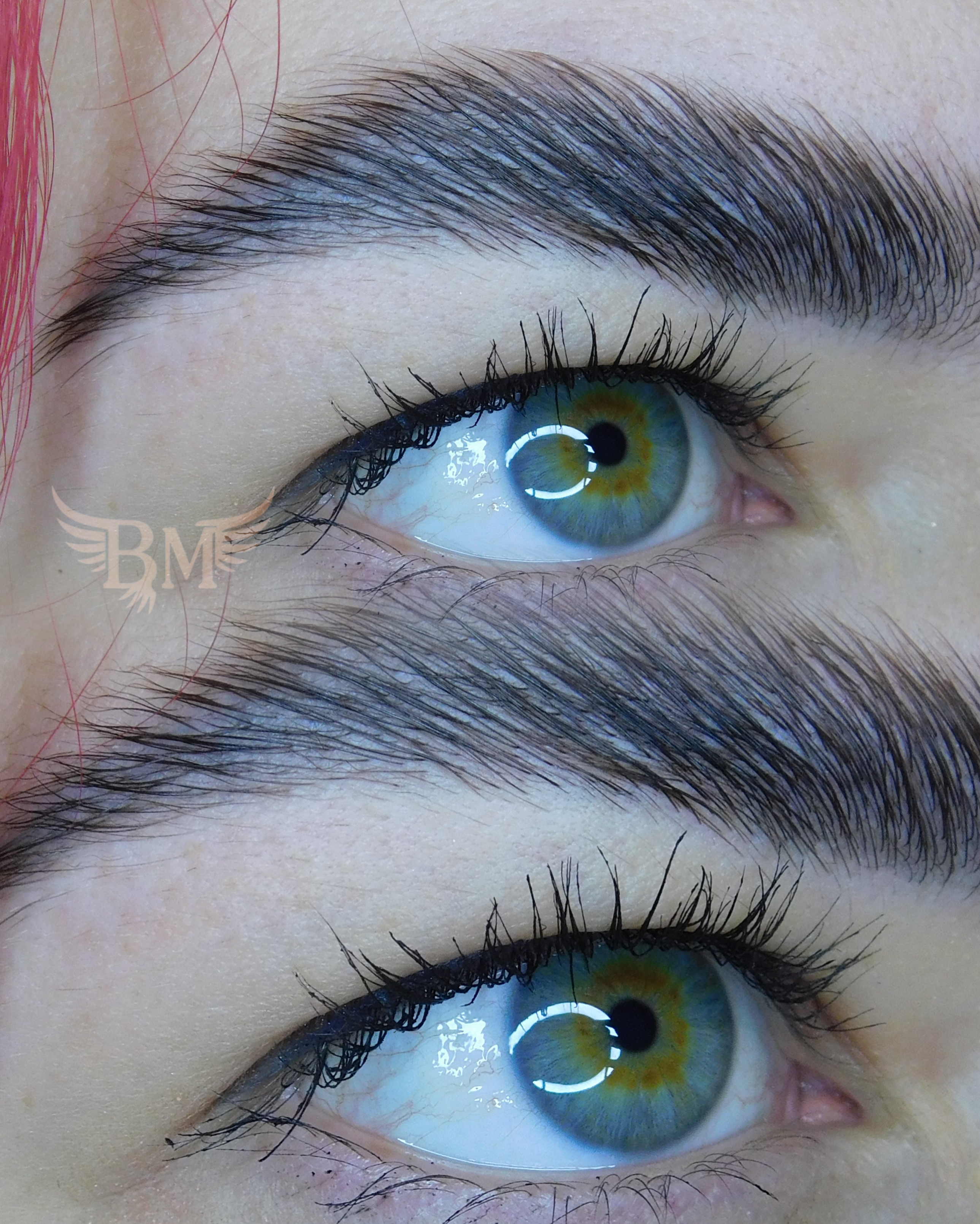 Brow lift
